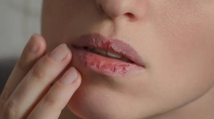 3 Bahan Ini Ampuh untuk Mengatasi Bibir Pecah-pecah